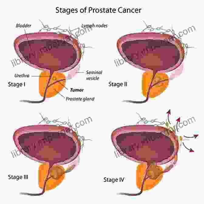 Diagram Of The Prostate And Surrounding Structures Affected By Cancer Dealing With Prostate Cancer: The Complete Guide To Diagnosis Treatment And Remedies