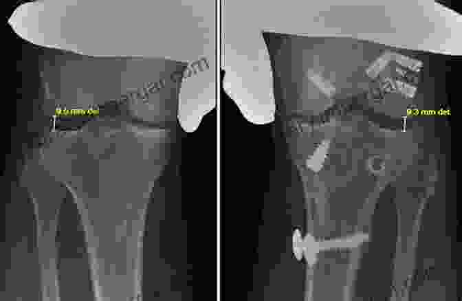 Image Of A Complex Knee Reconstruction Surgery Complications In Orthopaedics: Adult Reconstruction E