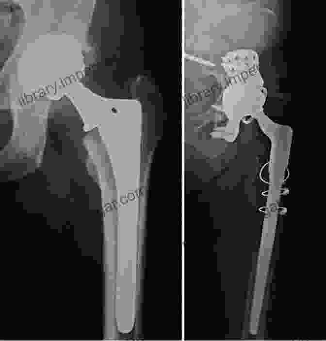 Image Of A Complex Revision Surgery For Failed Hip Arthroplasty Complications In Orthopaedics: Adult Reconstruction E